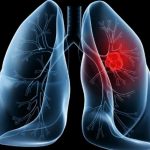 Saiba o que é adenocarcinoma pulmonar, câncer que atinge o papa